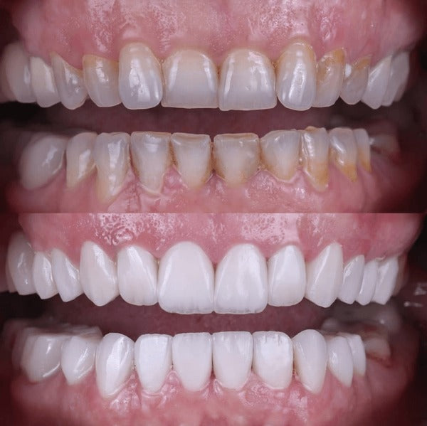 Bande blanchissante white smile